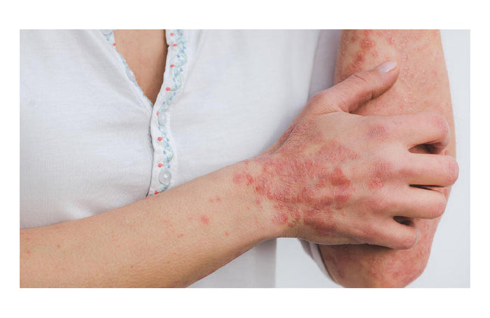 CBD und Psoriasis: Wie wirksam ist es?