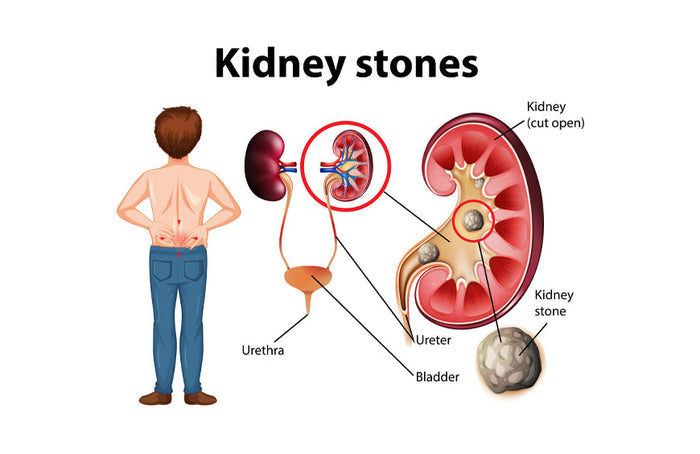 CBD und Nierenversagen: Alles, was Sie wissen müssen